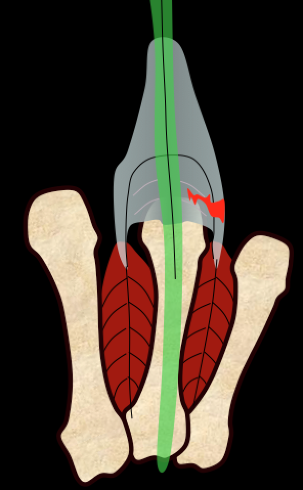 Sagittal band tear